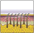 Before HPL Treatment