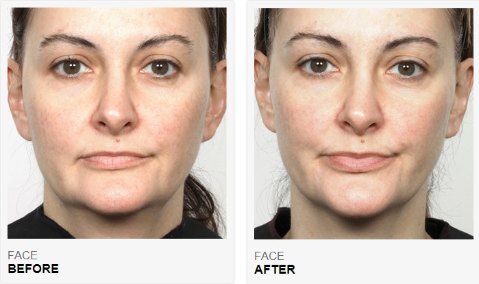 NuFACE Before After 1