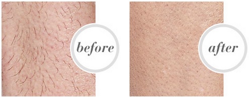 Tria Hair Removal Laser Precision Before and After 1