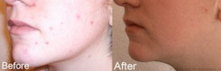 reVive Light Therapy Acne Before After 1
