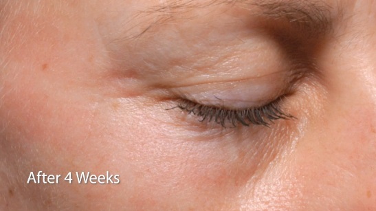 PaloVia Skin Renewing Laser 4 Weeks