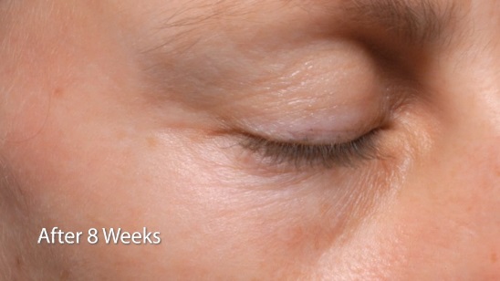 PaloVia Skin Renewing Laser 8 Weeks