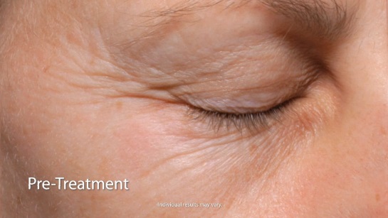PaloVia Skin Renewing Laser Pre-Treatment